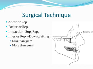 Surgical Technique
 Anterior Rep.
 Posterior Rep.
 Impaction -Sup. Rep.
 Inferior Rep. –Downgrafting
 Less than 3mm
 More than 3mm
 