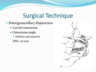 Surgical Technique
 Peterigomaxillary disjunction
 Curved osteotome
 Osteotome angle
 Inferior and anterior
DPA= 10 mm
 