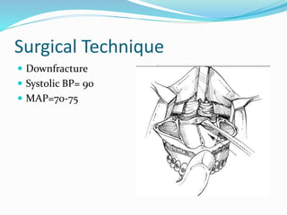 Surgical Technique
 Downfracture
 Systolic BP= 90
 MAP=70-75
 