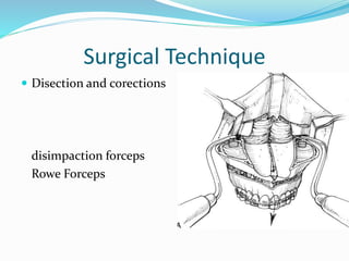 Surgical Technique
Excessive bone removal
1. Segmental instability
2. Lack of bone contanct
3. Excessive post. Impaction
4...