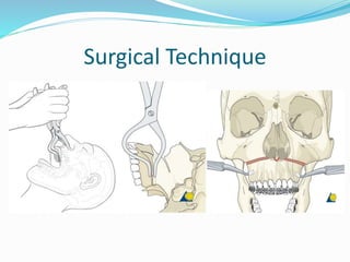 Surgical Technique
 