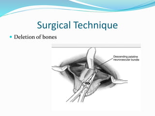 Surgical Technique
 Deletion of bones
 