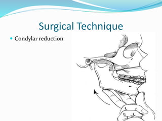 Surgical Technique
 Condylar reduction
 
