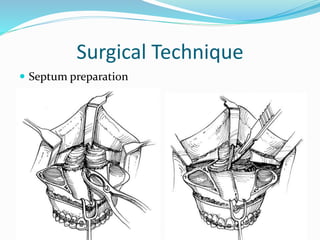 Surgical Technique
 Septum preparation
 
