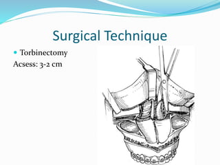 Surgical Technique
 Torbinectomy
Acsess: 3-2 cm
 