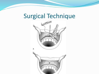 Surgical Technique
 