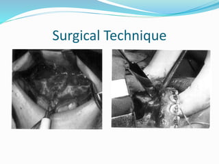 Surgical Technique
 