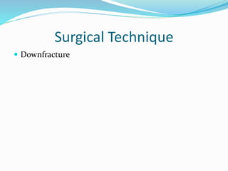 Surgical Technique
 Downfracture
 