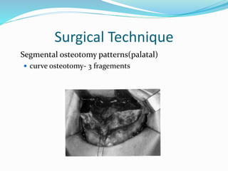Surgical Technique
Segmental osteotomy patterns(palatal)
 curve osteotomy- 3 fragements
 