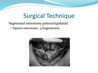 Surgical Technique
Segmental osteotomy patterns(palatal)
 Square osteotomy- 4 fragementss
 