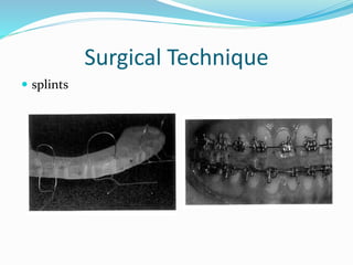 Surgical Technique
 splints
 