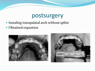 postsurgery
 Instaling transpalatal arch without splint
 Obtained expantion
 