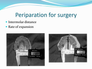Periparation for surgery
 Intermolar distance
 Rate of expansion
 