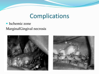 Complications
 Ischemic zone
MarginalGingival necrosis
 