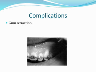 Complications
 Gum retraction
 