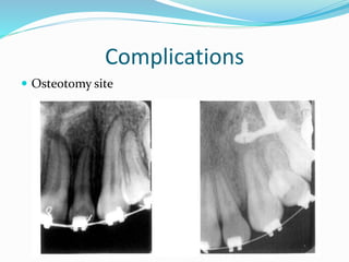 Complications
 Osteotomy site
 
