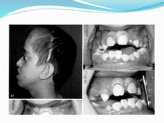 Diagnosis
 Alar base
 Nasolabial fold
 maxilla
 