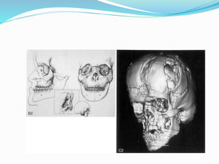 Clinical Evidenses
 Posterior crossbite
 Crowding
 Hourglass arch
 Deep palate
 Dental or skeletal
 