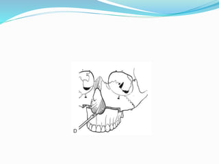maxillary osteotomies