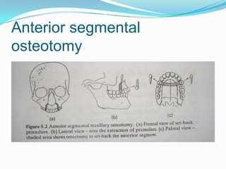 Maxilla  anatomy, development & surgical anatomy