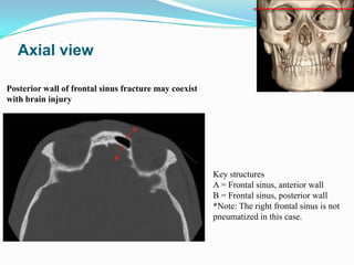 • Do not confuse the suture between nasal bone and
frontal process of maxilla for a fracture
• Look for a piece of fractur...