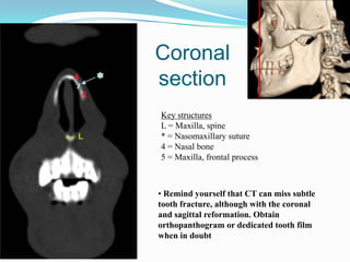 Key structures
D = Orbit, medial wall
M = Nasal septum
5 = Maxilla, frontal process
15 = Maxilla bone/ hard palate
16 = Fr...