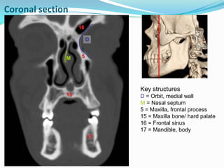 Key structures
M = Nasal septum
N = Ethmoid bone,
perpendicular plate
O = Orbit, roof
P = Orbit, floor
Q = Maxillary sinus...