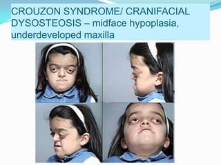 Marfan syndrome
 