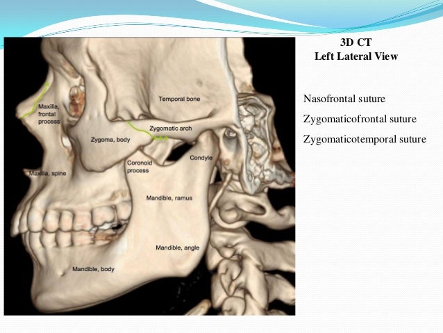 Maxilla anatomy, development & surgical anatomy