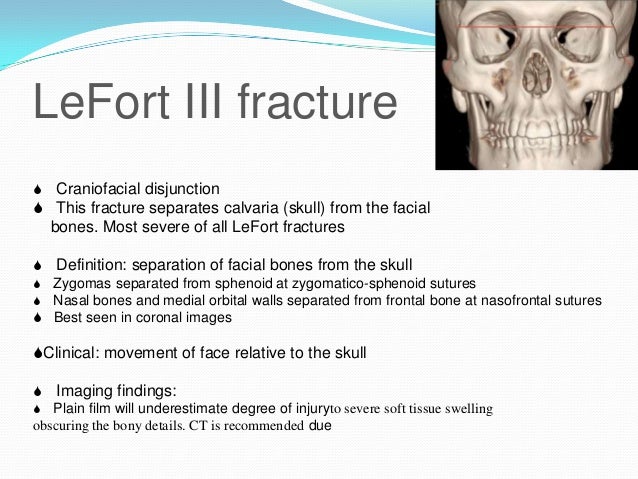 Maxilla anatomy, development & surgical anatomy