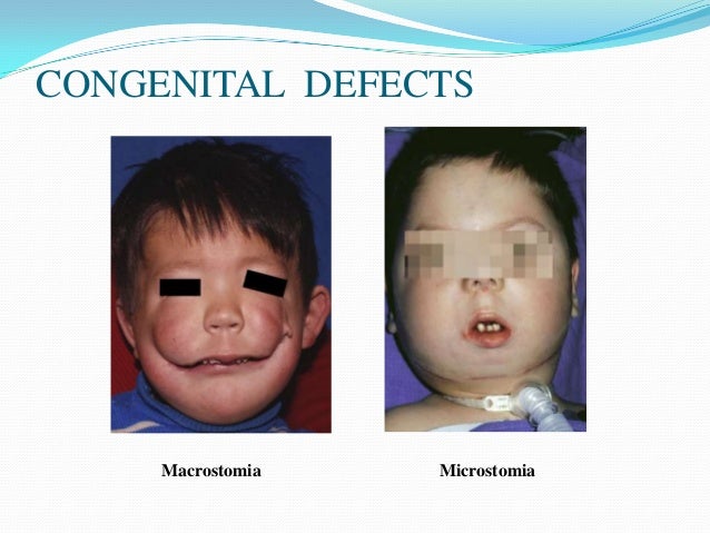 Maxilla anatomy, development & surgical anatomy