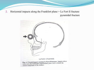 2. Horizontal impacts along the Frankfort plane = Le Fort II fracture
pyramidal fracture
 