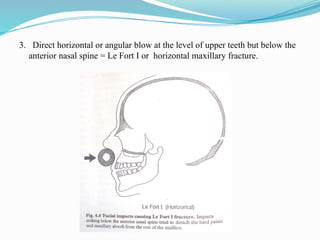 3. Direct horizontal or angular blow at the level of upper teeth but below the
anterior nasal spine = Le Fort I or horizontal maxillary fracture.
 