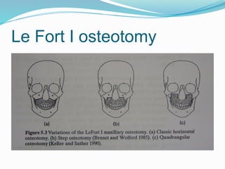 Le Fort I osteotomy
 