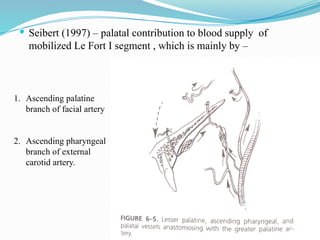  Seibert (1997) – palatal contribution to blood supply of
mobilized Le Fort I segment , which is mainly by –
1. Ascending palatine
branch of facial artery
2. Ascending pharyngeal
branch of external
carotid artery.
 