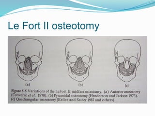 Le Fort II osteotomy
 