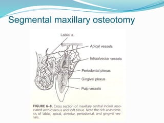 Segmental maxillary osteotomy
 