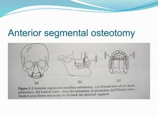 Anterior segmental osteotomy
 
