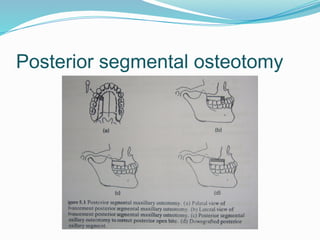Posterior segmental osteotomy
 
