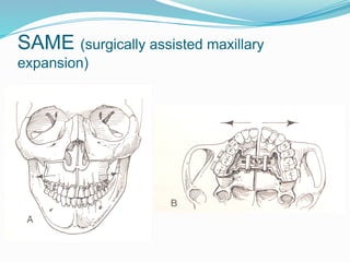 SAME (surgically assisted maxillary
expansion)
 
