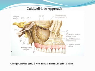 Caldwell-Luc Approach
George Caldwell (1893); New York & Henri Luc (1897); Paris
 