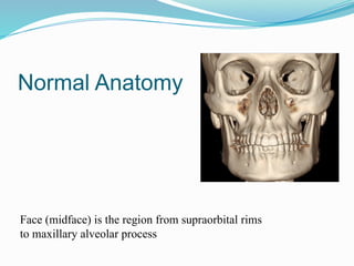 Normal Anatomy
Face (midface) is the region from supraorbital rims
to maxillary alveolar process
 