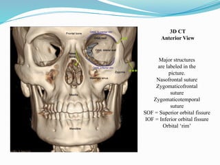 Major structures
are labeled in the
picture.
Nasofrontal suture
Zygomaticofrontal
suture
Zygomaticotemporal
suture
SOF = Superior orbital fissure
IOF = Inferior orbital fissure
Orbital ‘rim’
3D CT
Anterior View
 