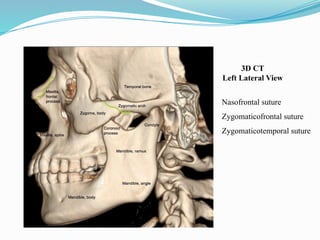 Nasofrontal suture
Zygomaticofrontal suture
Zygomaticotemporal suture
3D CT
Left Lateral View
 