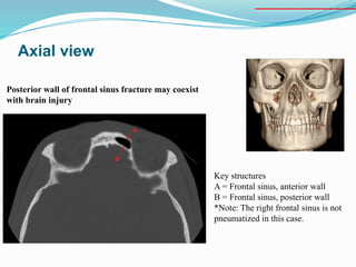 Axial view
Key structures
A = Frontal sinus, anterior wall
B = Frontal sinus, posterior wall
*Note: The right frontal sinus is not
pneumatized in this case.
Posterior wall of frontal sinus fracture may coexist
with brain injury
 