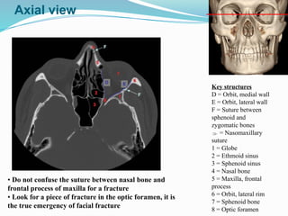 • Do not confuse the suture between nasal bone and
frontal process of maxilla for a fracture
• Look for a piece of fracture in the optic foramen, it is
the true emergency of facial fracture
Key structures
D = Orbit, medial wall
E = Orbit, lateral wall
F = Suture between
sphenoid and
zygomatic bones
 = Nasomaxillary
suture
1 = Globe
2 = Ethmoid sinus
3 = Sphenoid sinus
4 = Nasal bone
5 = Maxilla, frontal
process
6 = Orbit, lateral rim
7 = Sphenoid bone
8 = Optic foramen

Axial view
 
