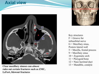 Clear maxillary sinuses can almost
rules out certain fractures such as ZMC,
LeFort, blowout fractures
Key structures
F = Groove for
infraorbital nerve
G = Maxillary sinus,
Postero lateral wall
5 = Maxilla, frontal process
9 = Maxillary sinus
10 = Zygomatic arch
11 = Pterygoid bone
12 = Naso lacrimal duct
13 = Mandible, condyle
Axial view
 