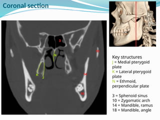 Key structures
J = Medial pterygoid
plate
K = Lateral pterygoid
plate
N = Ethmoid,
perpendicular plate
3 = Sphenoid sinus
10 = Zygomatic arch
14 = Mandible, ramus
18 = Mandible, angle
Coronal section
 