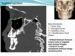 Key structures
P = Orbit, floor
7 = Pterygoid bone
9 = Maxillary sinus
15 = Maxilla bone /hard
Palate
• Orbital blowout fracture
is best seen in sagittal
and coronal images
• Facial CT is not
completed without image
reconstruction
Sagittal section
 