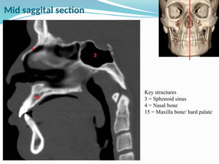Key structures
3 = Sphenoid sinus
4 = Nasal bone
15 = Maxilla bone/ hard palate
Mid saggital section
 